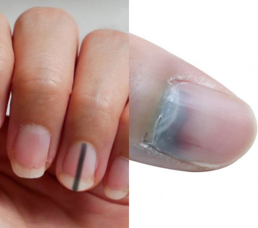 Do You Know Having Black Lines On Your Nails Can Kill Globecalls Com