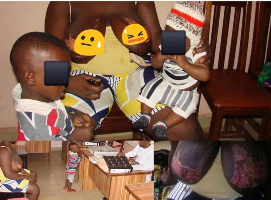 Man Pours Hot Water On His Breastfeeding Wife's Breast