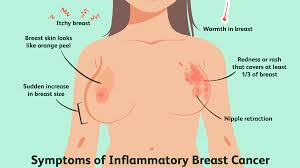 Early Signs Of Breast Cancer, Survivor's Testimony