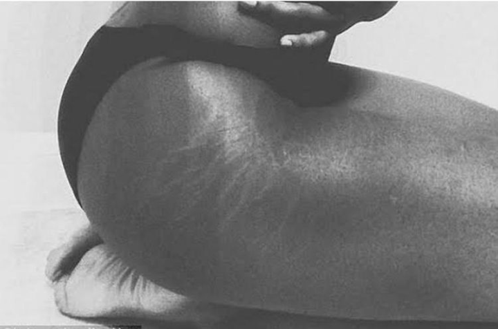 5 Fun Facts About Stretch Marks